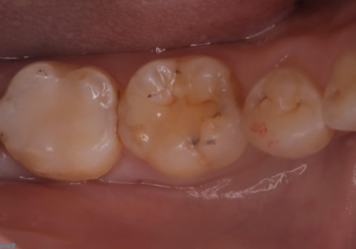 【セラミックインレー】プラスチックの詰め物をセラミックにしたいの症例 治療後