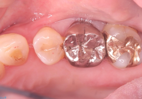 フロス通したら詰め物が取れたの治療後