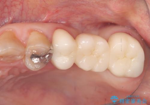 奥歯の奥側からよく汚れが出てくるの症例 治療後