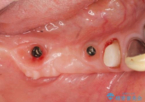 狭小な歯槽骨に対するインプラント治療の治療中