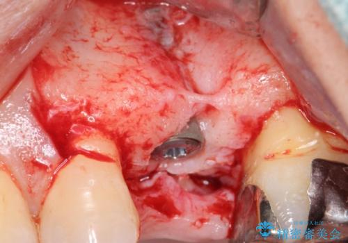 歯茎が腫れる インプラントでの治療の治療後