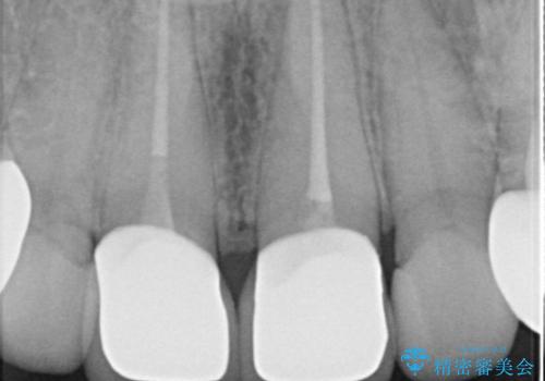 【セラミッククラウン】他院で治療したセラミッククラウンをやりかえたいの治療後