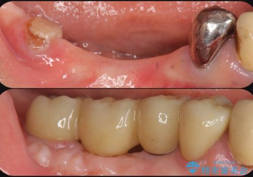 狭小な歯槽骨に対するインプラント治療