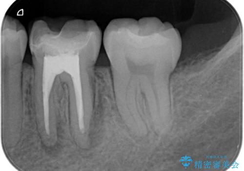 【歯根端切除術】根っこの先端の病気が治らないの症例 治療前