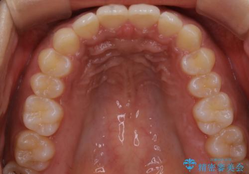 インビザライン矯正 歯を抜かずに出っ歯を改善!の治療後