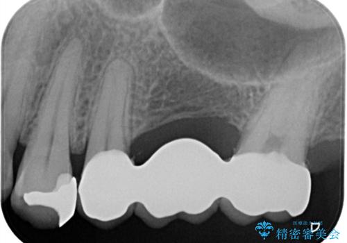 【セラミッククラウン】【ブリッジ】奥歯の奥側からよく汚れが出てくるの治療後