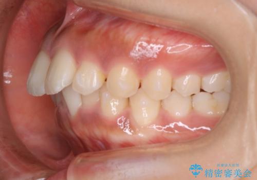 インビザライン矯正 歯を抜かずに出っ歯を改善!の治療中