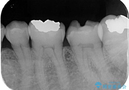【セラミックインレー】詰め物が外れた 白くしたいの治療前