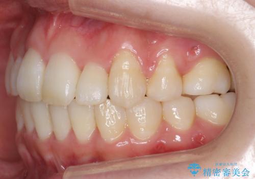 難症例 奥歯がかみ合っていない 歯並び矯正で別人にの治療後