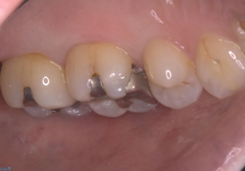 詰め物と歯の境目に汚れが溜まるの治療前