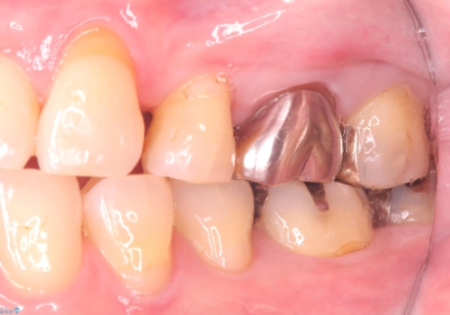 フロス通したら詰め物が取れたの治療後