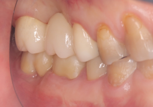奥歯の奥側からよく汚れが出てくるの治療後