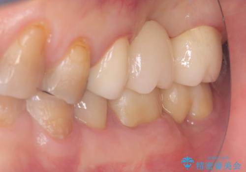 【セラミッククラウン】【ブリッジ】奥歯の奥側からよく汚れが出てくるの治療後