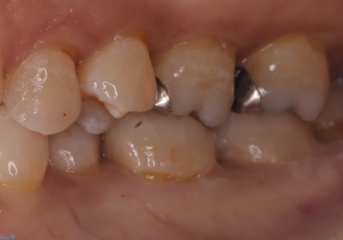 【セラミックインレー】詰め物が外れた 白くしたいの治療後