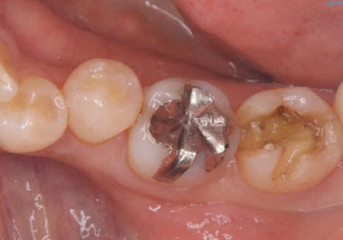 【セラミックインレー】詰め物が外れた 白くしたい