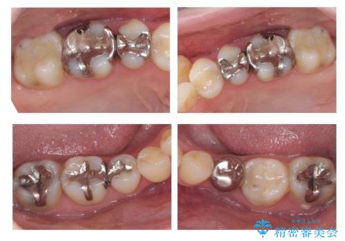 全体的な虫歯治療　銀歯をセラミックにの治療前