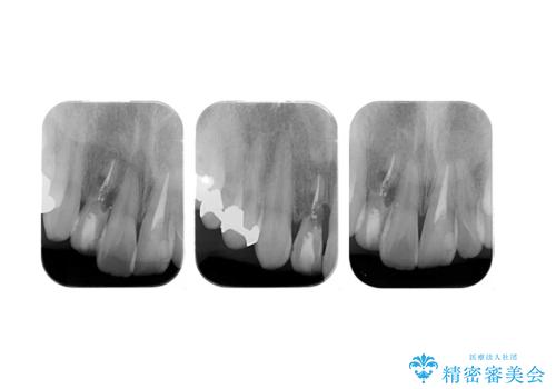 前歯をやむなく抜歯　ブリッジに　治療ついでに歯並びもよくの治療前
