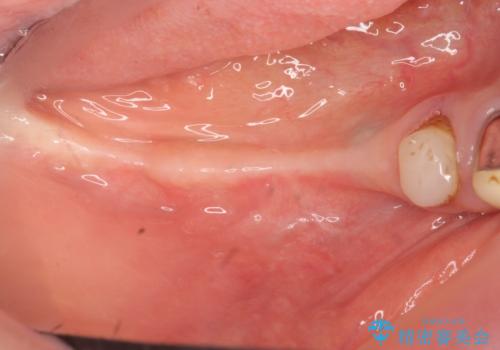 狭小な歯槽骨に対するインプラント治療の治療前