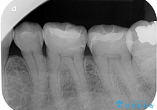 【セラミックインレー】詰め物が外れた 白くしたいの治療後