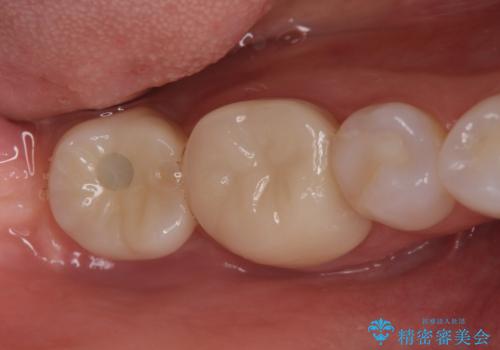 伸びてしまった奥歯、咬合平面を揃えたインプラント治療の治療後