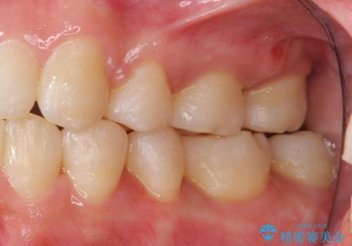 難症例　奥歯がかみ合っていない　歯並び矯正で別人にの治療後