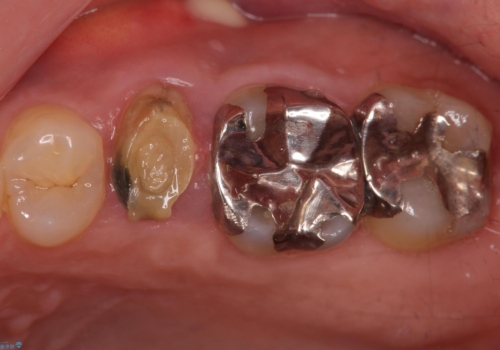 歯茎が腫れる　インプラントでの治療の症例 治療前
