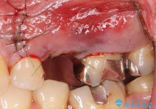 歯茎が腫れる　インプラントでの治療の治療後