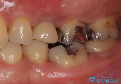 歯茎が腫れる インプラントでの治療の治療後