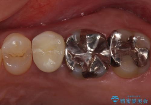 歯茎が腫れる　インプラントでの治療の症例 治療後