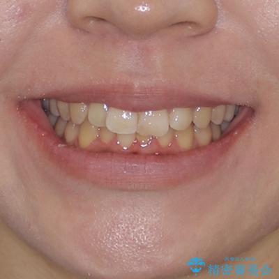 前歯のデコボコをインビザライン矯正で綺麗に改善の治療前(顔貌)