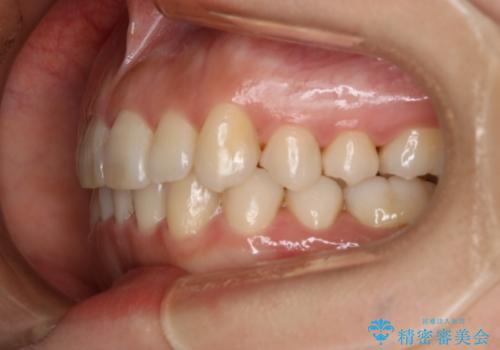インビザライン矯正 短期間でがたつきのないきれいな歯並びにの治療後