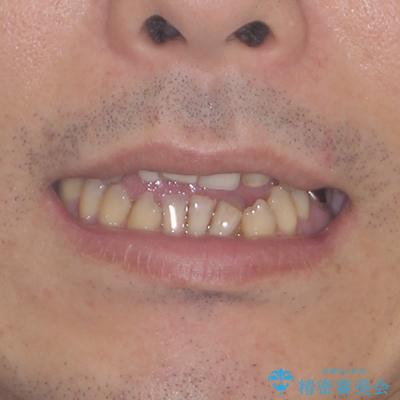 外科手術を検討? 過大な開咬をワイヤー装置とインビザラインで劇的に改善するの治療前(顔貌)