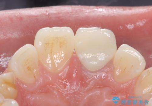 変色した前歯 ジルコニアクラウンでの修復の治療後