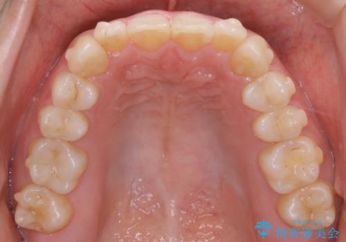 インビザライン矯正 短期間でがたつきのないきれいな歯並びにの治療中