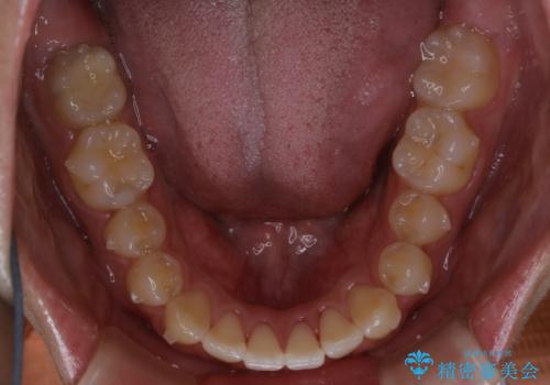 インビザライン矯正 過去に矯正治療したが、また前歯にがたつきがでてきて治したいの治療中