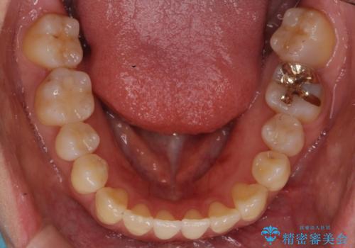 前歯のがたつき 若干受け口 インビザラインでの治療後