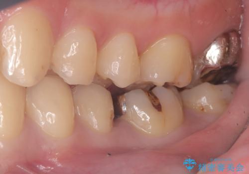 【セラミックインレー】詰め物が外れたので、ついでに白くしたいの治療前