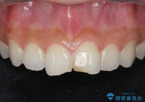 すり減った前歯の形態回復の症例 治療前
