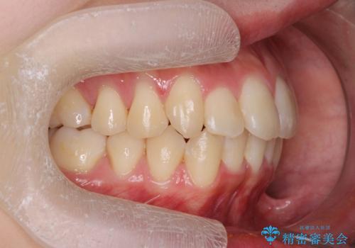 前歯のがたつきをマウスピース矯正できれいに!の治療後