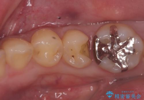 【セラミックインレー】詰め物が外れたので、ついでに白くしたいの症例 治療前