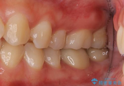 保険治療のプラスチックが劣化し虫歯に。　セラミックでつぎはぎなく治療の治療後