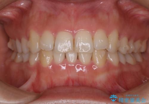 インビザライン矯正 短期間でがたつきのないきれいな歯並びにの治療中