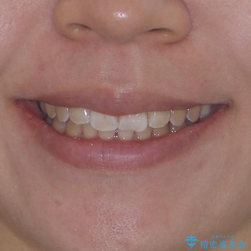 前歯のデコボコをインビザライン矯正で綺麗に改善の治療後(顔貌)
