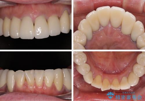 治療を開始したもののうまく噛めない 咬合改善のオールセラミック補綴治療の治療後