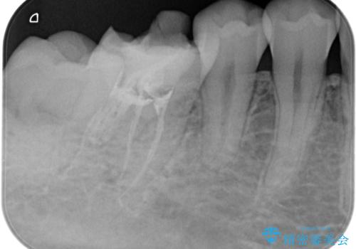 【根管治療】ラバーダムと顕微鏡を用いた治療の治療前