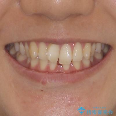 下顎前歯の欠損歯列 ワイヤー装置での矯正治療の治療前(顔貌)