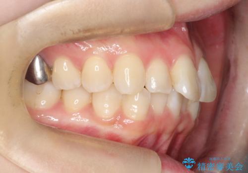 前歯のガタつきをマウスピース矯正で改善