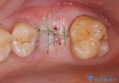 失った咬合機能の回復 インプラント治療の治療中