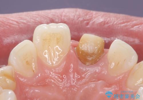 変色した前歯 ジルコニアクラウンでの修復の治療中