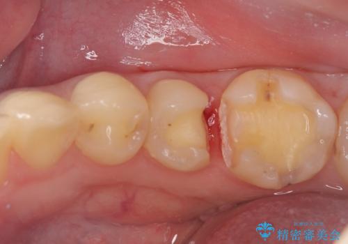 【セラミックインレー】詰め物が外れたので、ついでに白くしたいの治療中